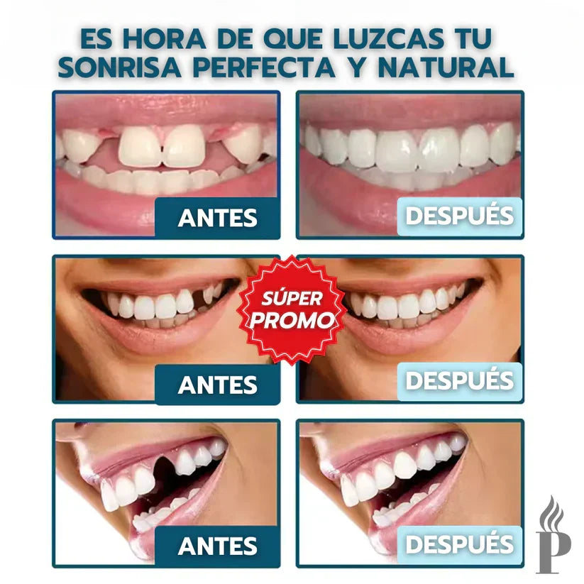 Snap-On Smile™: Carillas Dentales Ajustables - Dientes de Cerámica